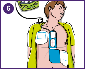 6 - Anbring stødpads