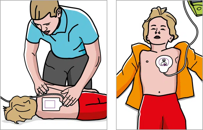 Placering af stødpads på børn over 1 år Placering af stødpads på børn over 1 år