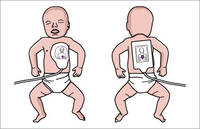 Placering af stødpads på børn under 1 år Placering af stødpads på børn under 1 år